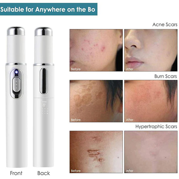 Acne Wrinkle Removal Laser Pen Skin