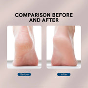 Foot Callus Remover