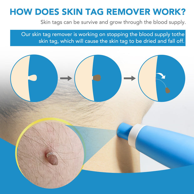 MicroCare Skin Solution - Advanced Skin Tag, Wart, Acne, and Pimple Removal Kit