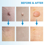 MicroCare Skin Solution - Advanced Skin Tag, Wart, Acne, and Pimple Removal Kit