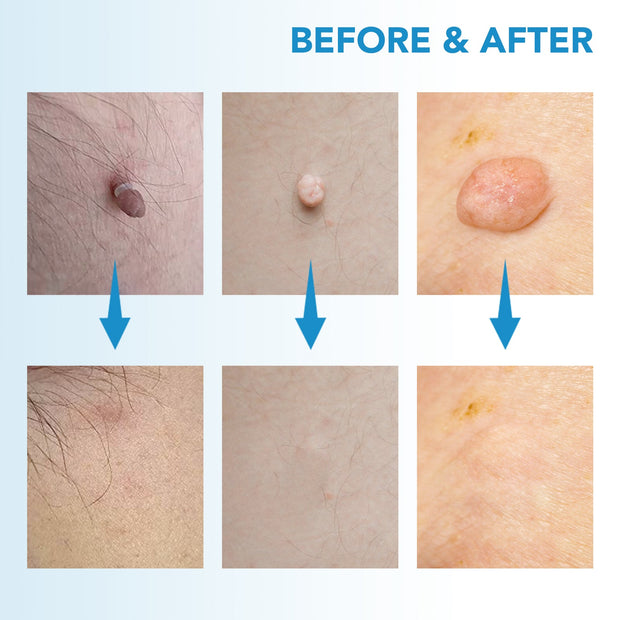 MicroCare Skin Solution - Advanced Skin Tag, Wart, Acne, and Pimple Removal Kit