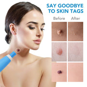 MicroCare Skin Solution - Advanced Skin Tag, Wart, Acne, and Pimple Removal Kit