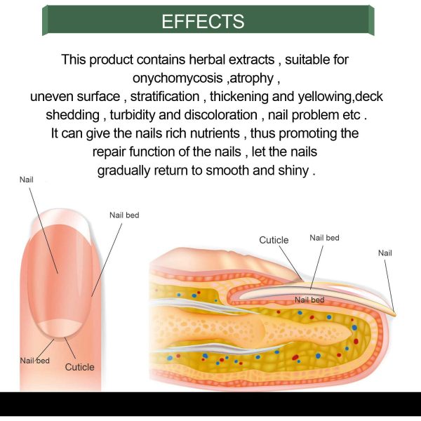 Nail Fungus Solution