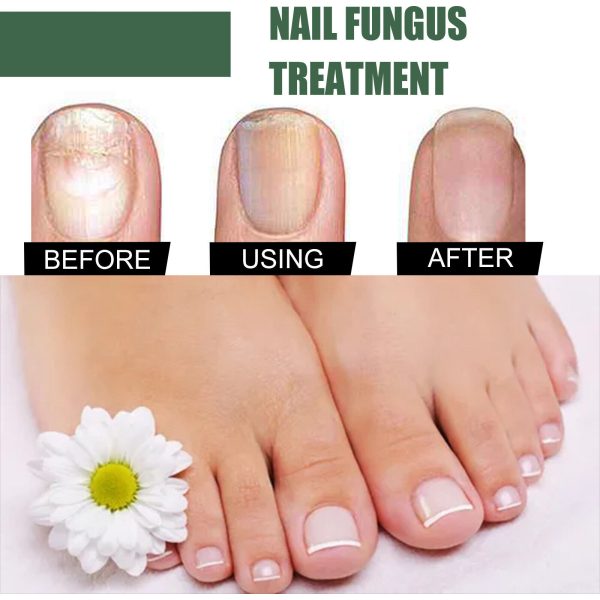 Nail Fungus Solution